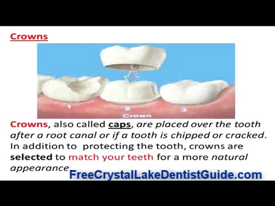 Do You Really Need A Root Canal?