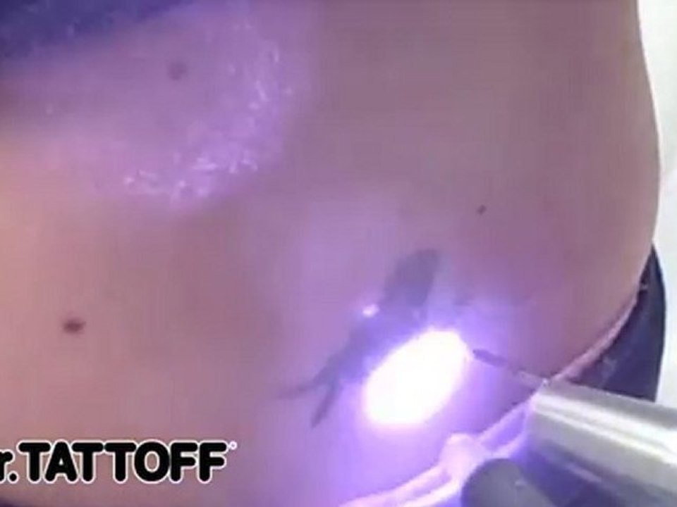 Tattoo Removal - Tribal Sunflower on Lower Back