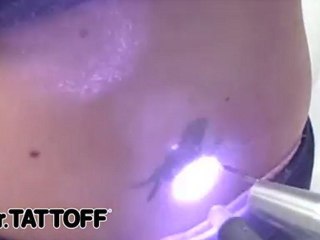 Tattoo Removal - Tribal Sunflower on Lower Back