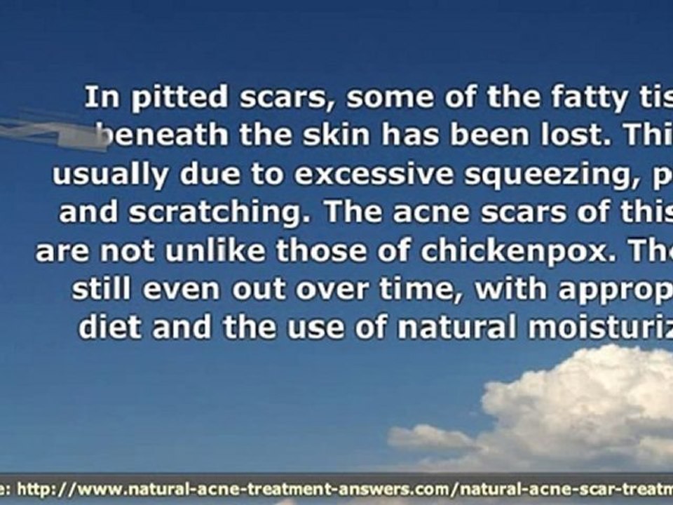 Natural Acne Scar Treatment For Deep Scars - How to Quickly