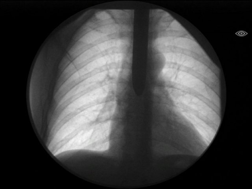 Moving X-ray Fluoroscope: Sword Swallower Swallowing Swords!