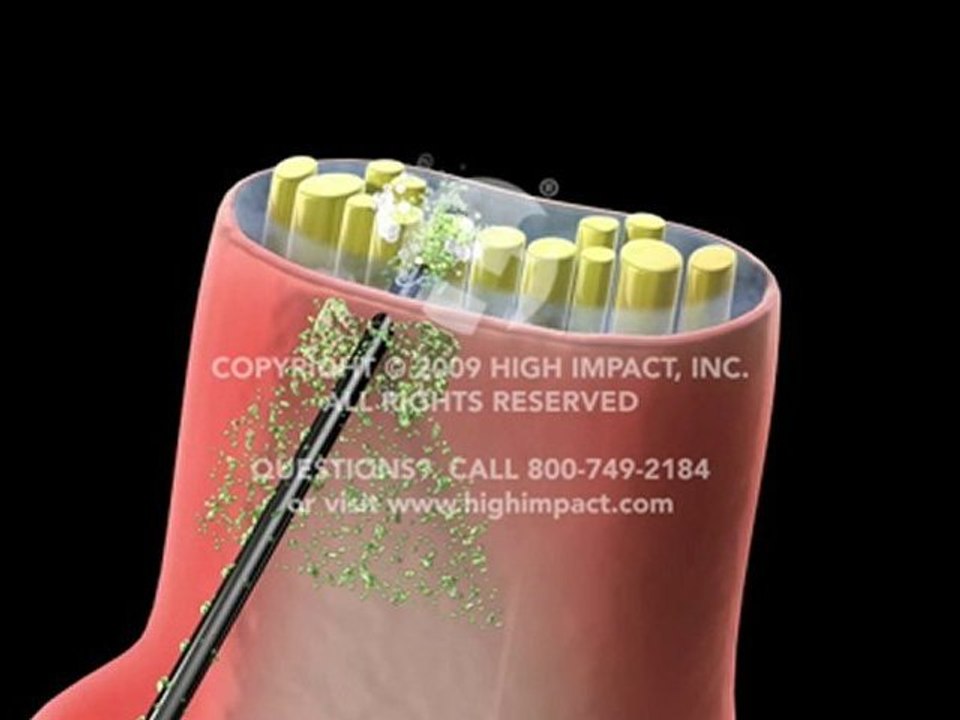 Complications from Injection