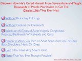 Ultimate Natural Acne Cures and Learn How To Cure It