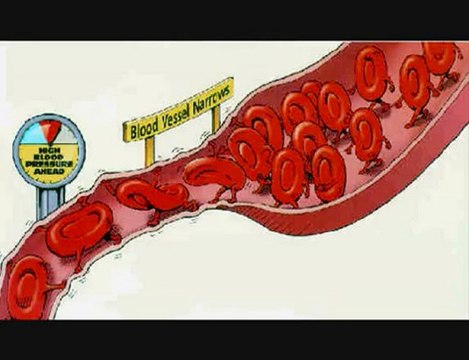 What Causes High Blood Pressure and High Pulse Rate