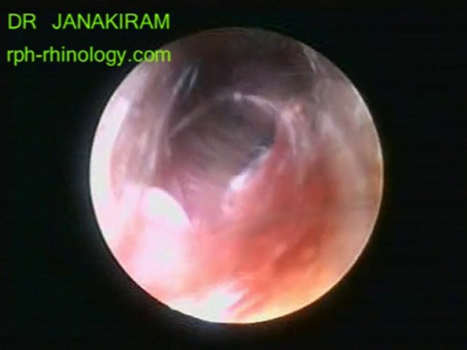DR JANAKIRAM ENT VIDEOS aural polyp ear