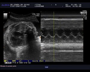 echo 1er juin battements du coeur
