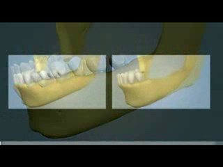Kemik Greftleme - Yan Kemikten Alıp Uygulama