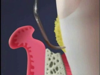 PERİODONTAL PROBLEM SONUCU OLUŞAN KEMİK RESORBSİYONU