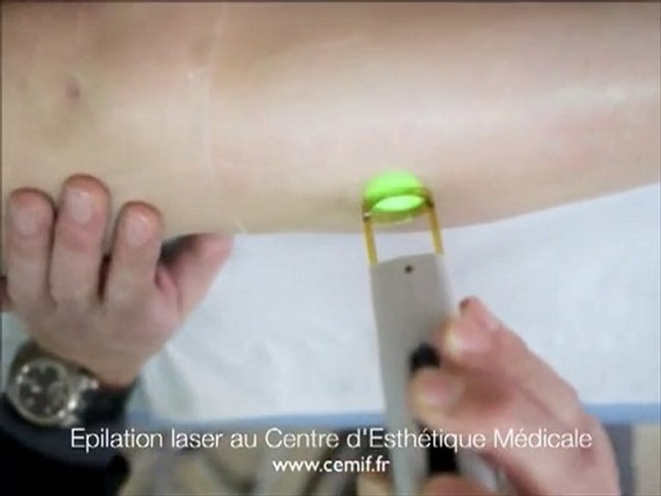 Epilation laser : Vidéo d'une séance d'épilation au laser