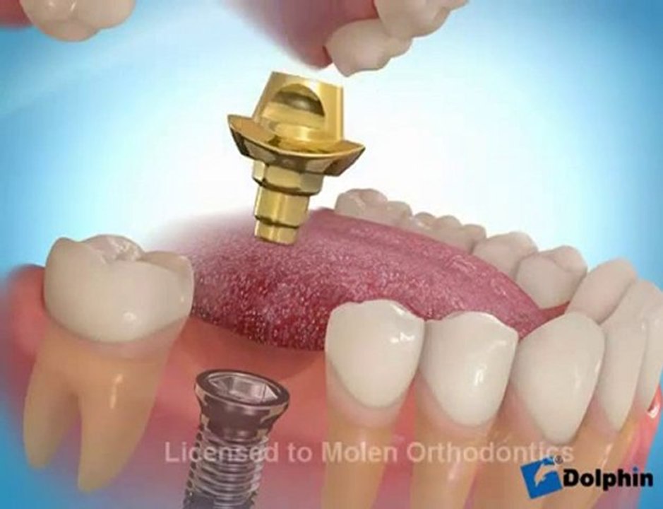 arka diş implant