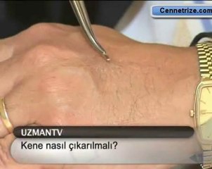 Kene Nasıl Cıkartılır