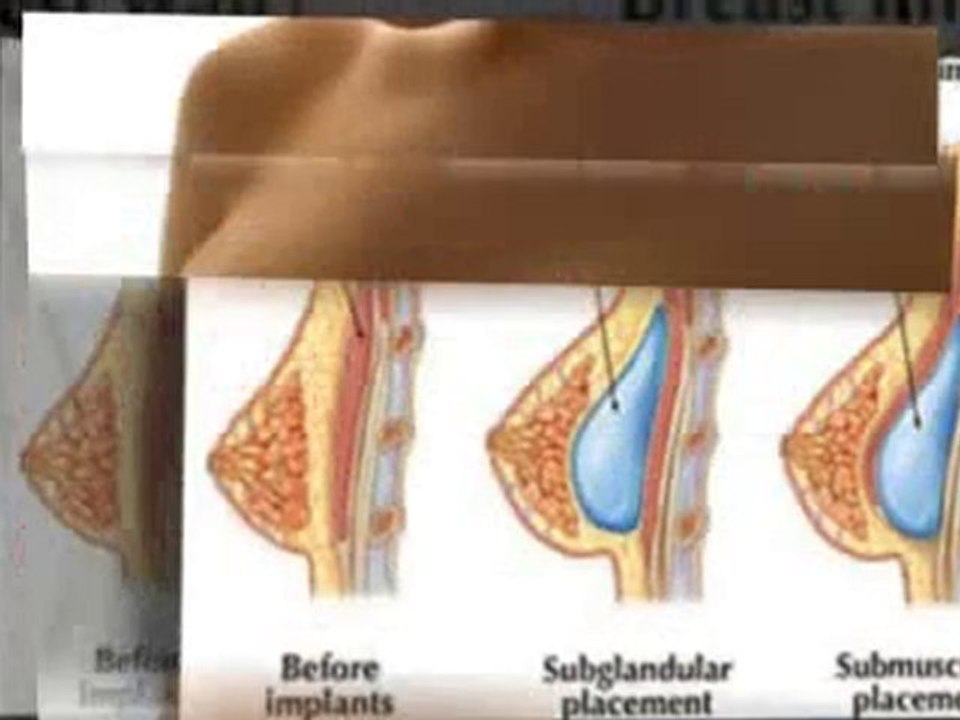 Breast Implants High Profile