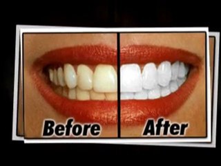 Get teeth whitening Oxford done by professional Oxford Dent