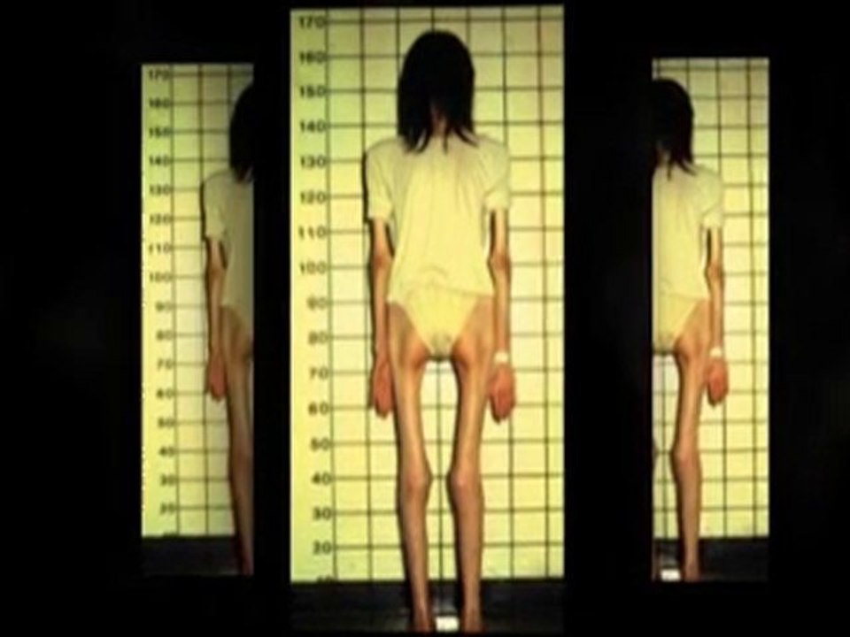 Anorexia. Eating disorders. Binge eating nerviosa. Anorexic