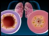 Natural Bronchitis cure. Treatment and symptoms.