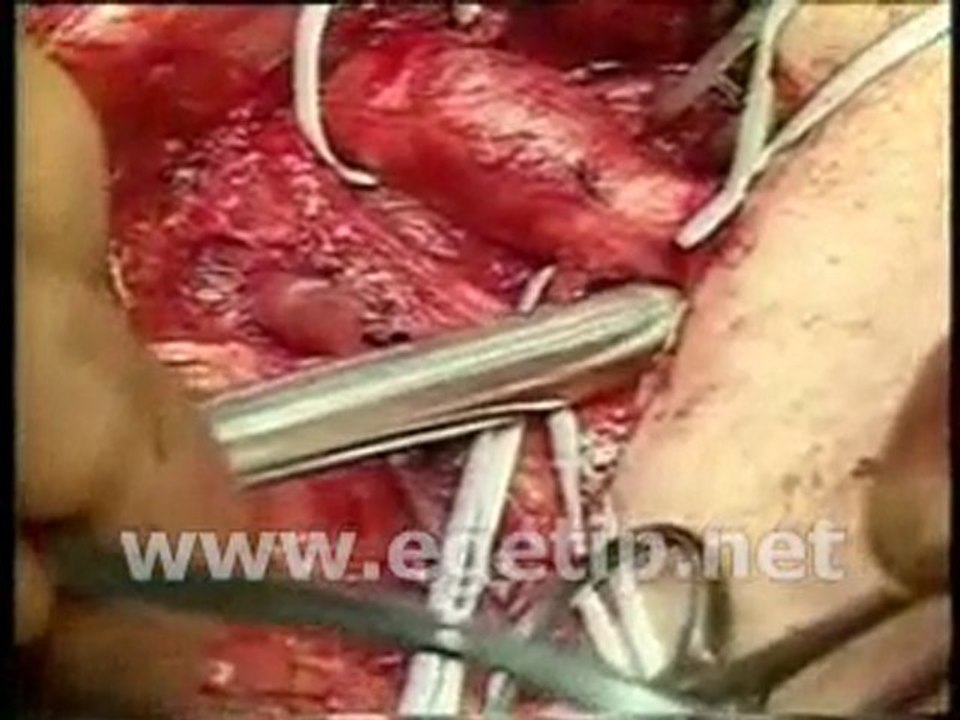 Forum Ege Tıp - Femoral Bypass