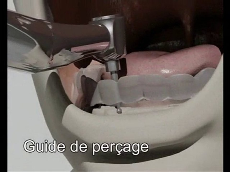 Système Quattro sur la mandibule