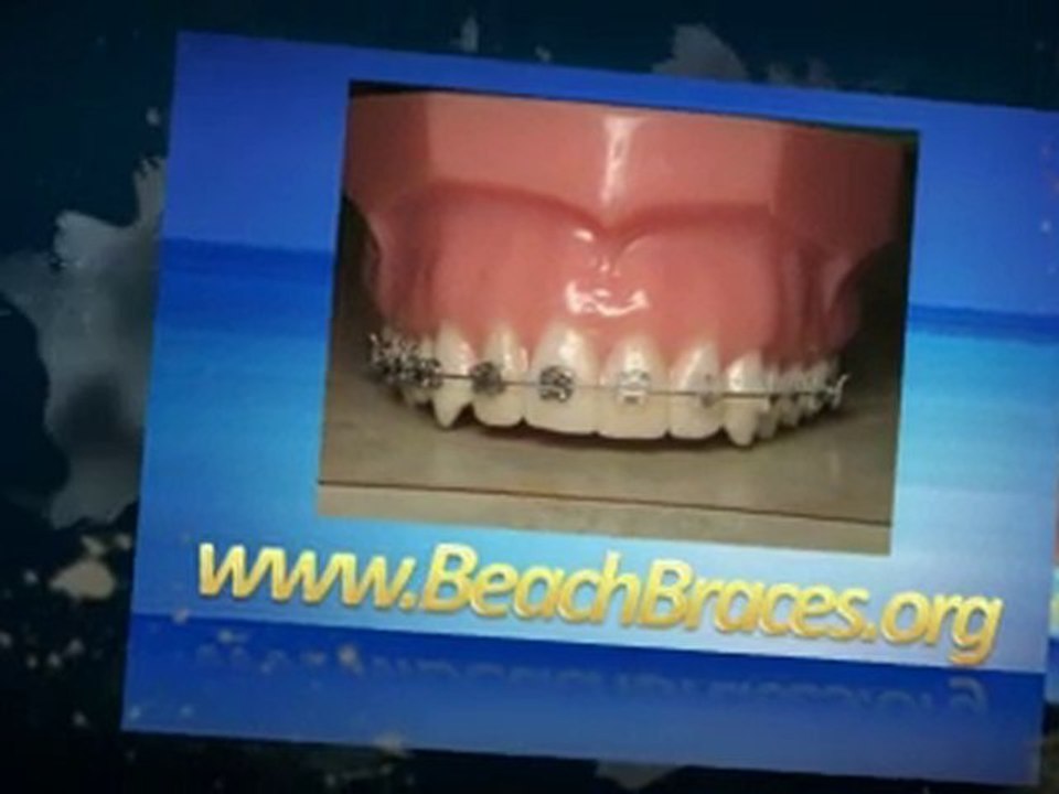Beach Braces - Orthodontic Braces Brands