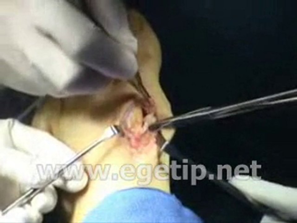 Forum Ege Tıp - Bunyonektomi 2. Kısım