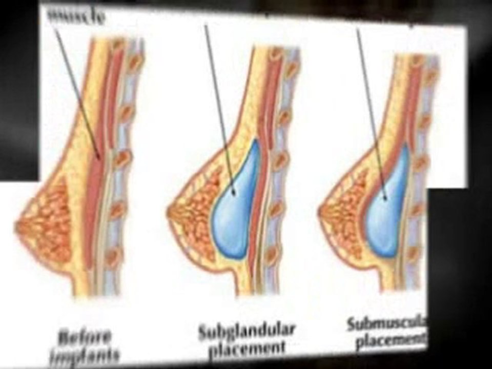 Belly Button Breast Augmentation