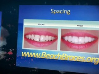 Beach Braces - Common Orthodontic Problems