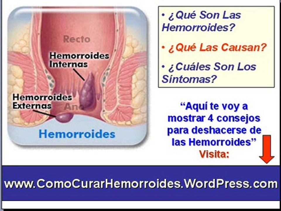 Como curar las hemorroides - Como eliminar las hemorroides