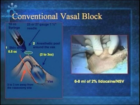 No Needle Anesthesia for Vasectomy One