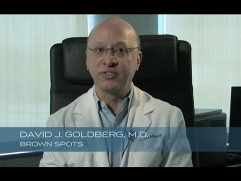 Removing unwanted age spots or brown spots with Dr. Goldberg