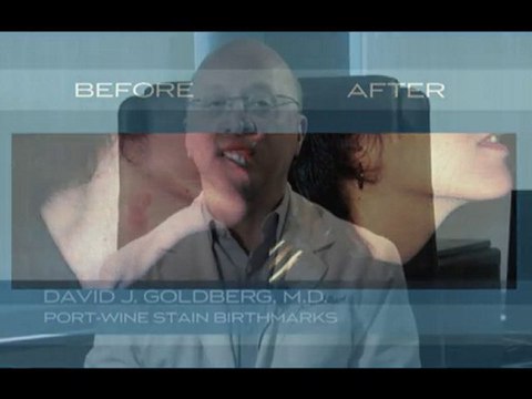 Port-Wine Stain Birthmarks treated by Dr. David Goldberg NY