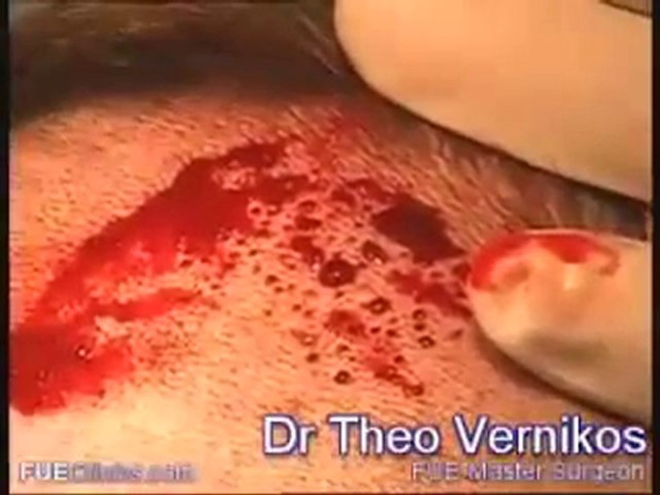 Fue Hair Transplant