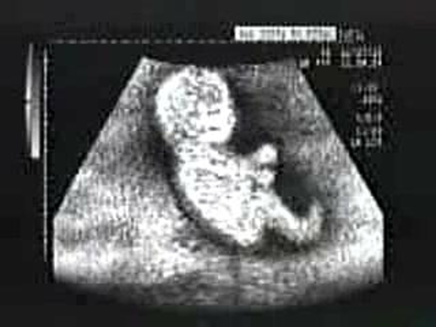 Humour Echographie Video Dailymotion