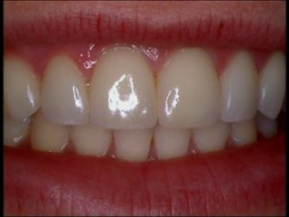 Dear Dr. Harrouff, Why would I ever need Porcelain Crowns?