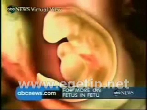 Forum Ege Tıp - Yapışık İkizler