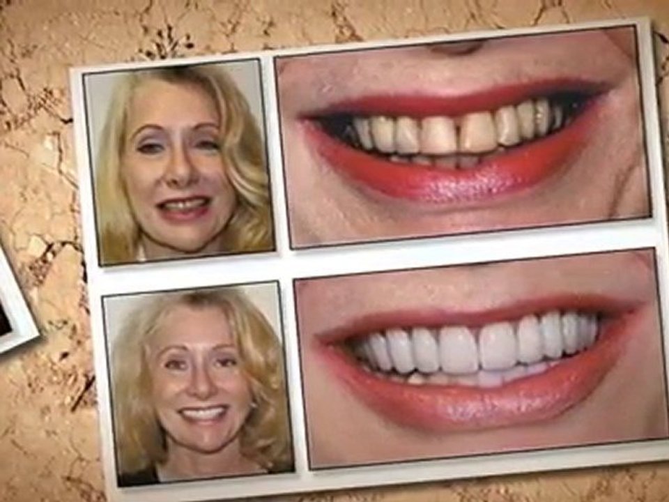 Teeth Whitening Woodland Hills Dentist