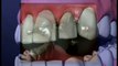 Wade Harrouff - Why use Crowns after a root canal?