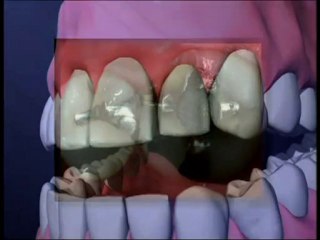 Wade Harrouff - Why use Crowns after a root canal?