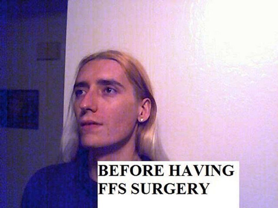 Facial feminization surgery with Dr Douglas Ousterhout