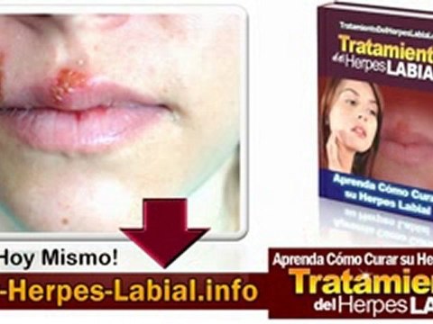 Del Herpes Labial - Tratamiento del Herpes Labial