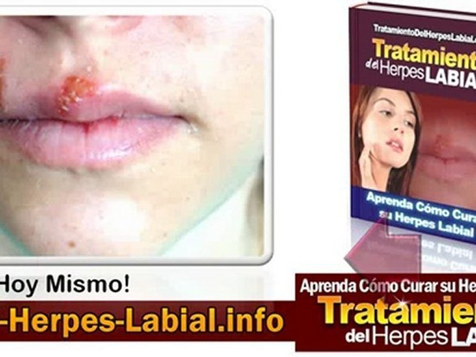 Virus Herpes Labial - Tratamiento del Herpes Labial
