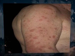 Black Mold Removal Bergenfield NJ