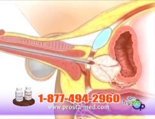 Cancer y Tratamiento prostata inflamada