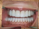 Dental Implants Woodland Hills Dentist