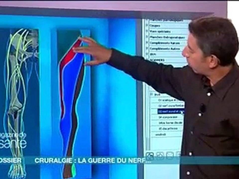 La Cruralgie
