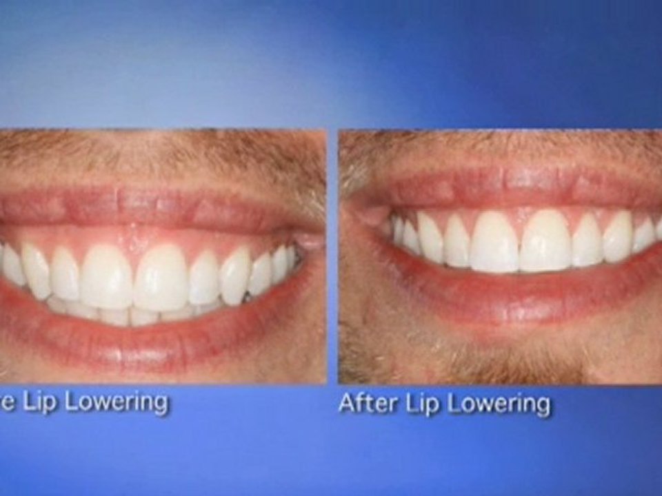 Patient Discusses His Los Angeles Smile Makeover