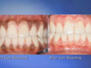 Model Discusses Dark Gums in Beverly Hills
