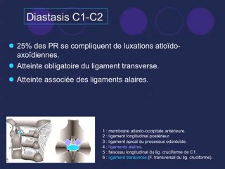 Un diastasis caché