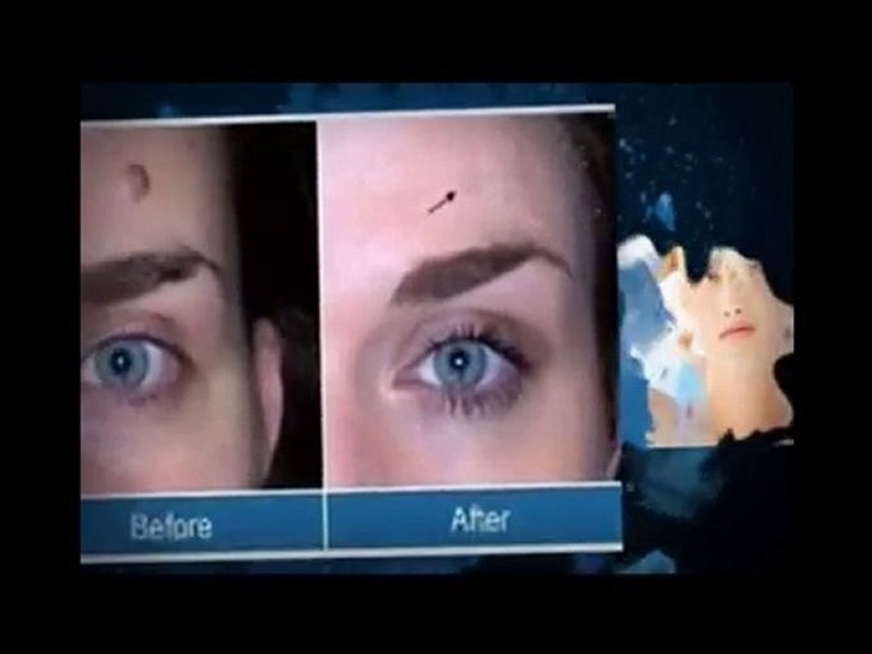 Home mole and warts removal