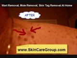 How To Remove Skin Tags,Warts, Moles at home with no cuttin
