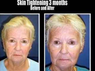 Mini Lift Mini Facelift Punta Gorda Florida with Dr. Stampar