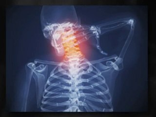 Auto Accident and Whiplash